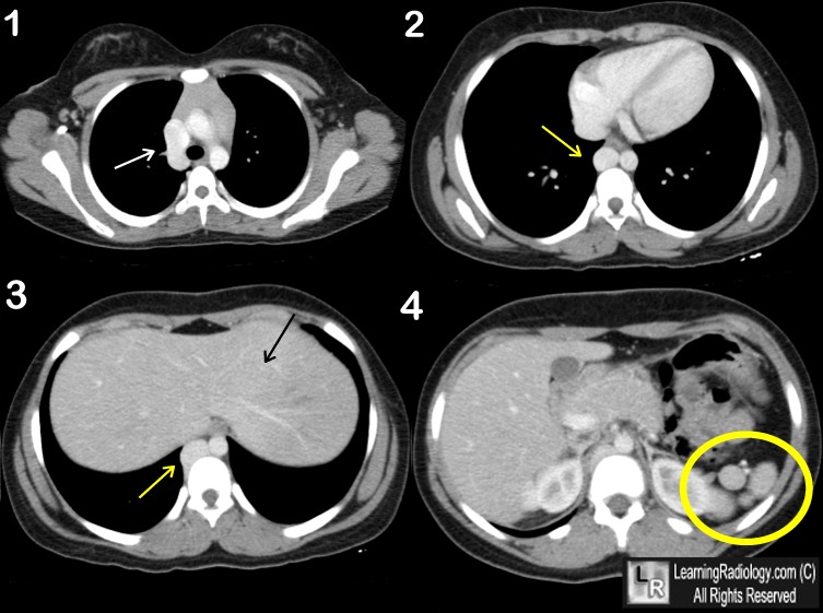 Interruption of Inferior Vena Cava (IVC)